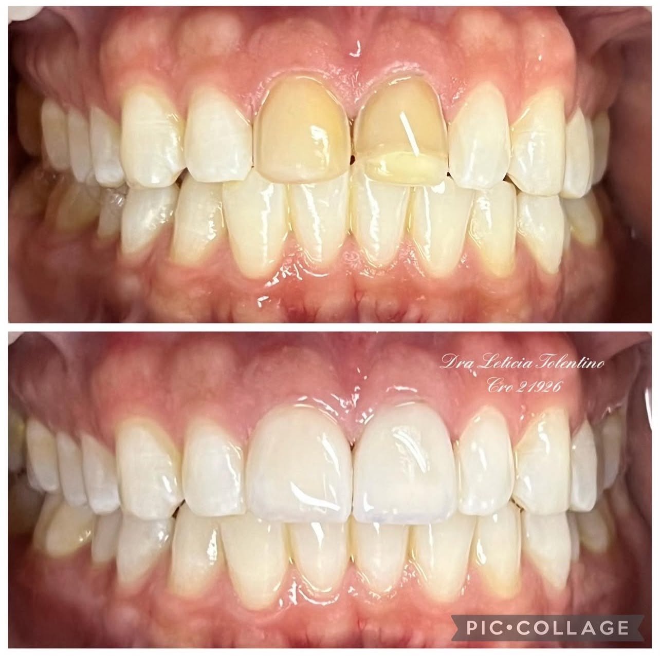Resultado de tratamento odontológico da Drª Letícia Tolentino 4